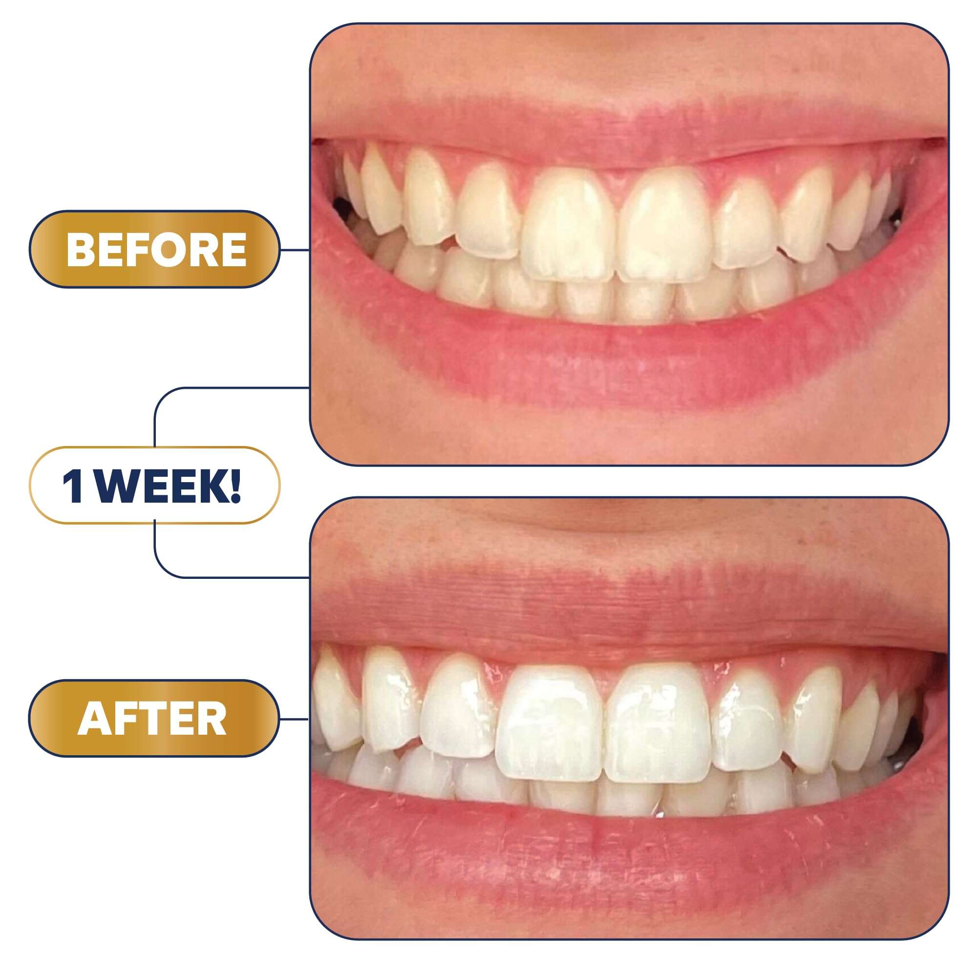 Lumineux Teeth Whitening Strips 21 Treatments – Peroxide Free - Enamel Safe for Whiter Teeth - Whitening Without The Sensitivity - Dentist Formulated - Sensitivity - Image 3