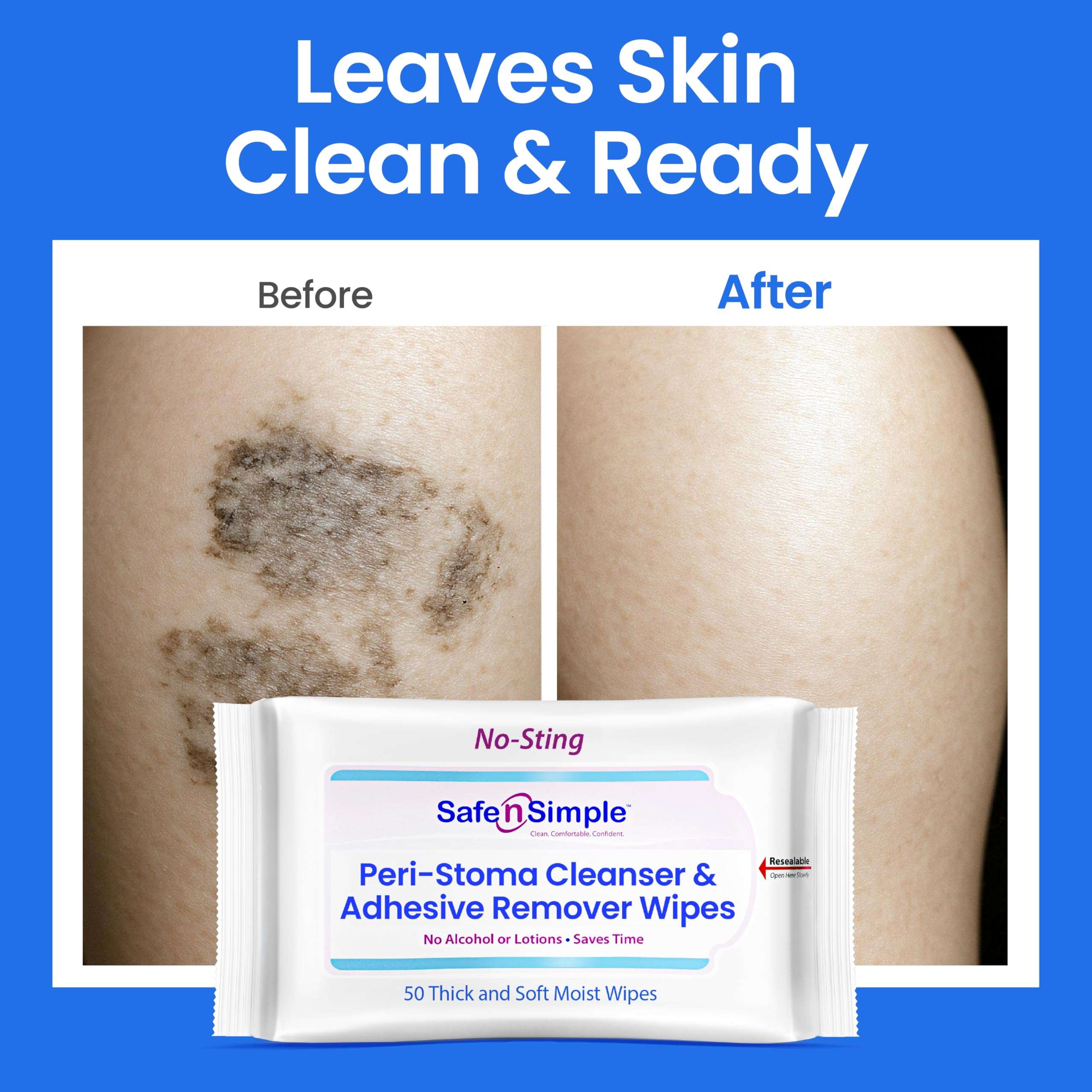 Safe n’ Simple Resealable Adhesive Remover Wipes for Skin - 50 Large 5"x7" No Sting Alcohol Free Medical Adhesive Remover Pads for Ostomy, Stoma Care - Gentle Adhesive Removal Wipes for Bandages, Tape - Image 7