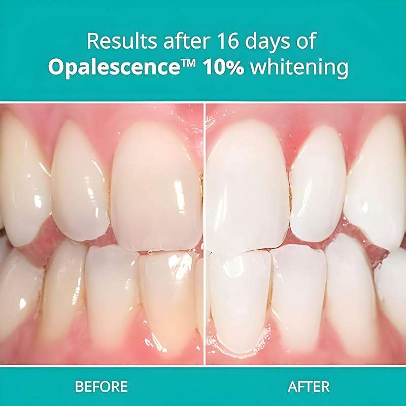 Opalescence 10% Gel Syringes Teeth Whitening - Refill Kit (4 Syringes Total) Carbamide Peroxide. Made by Ultradent, in Melon Flavor. Tooth Whitening Refill Syringes - Image 3