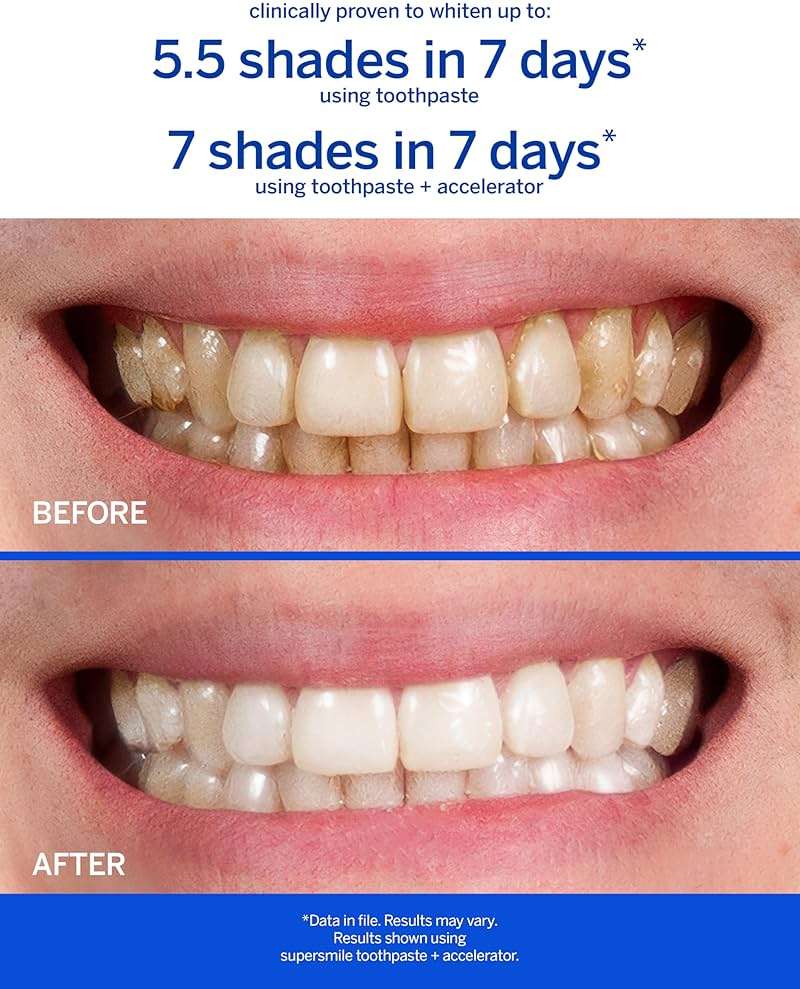 Supersmile Teeth Whitening System - Whitening Toothpaste and Accelerator - Whitens Up to 7 Shades - Image 3