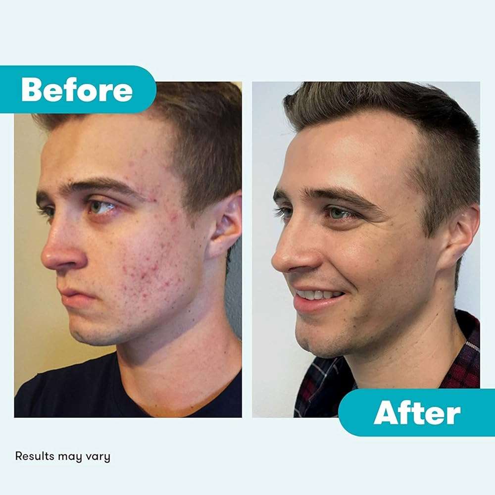 Proactiv Acne Cleanser - Benzoyl Peroxide Face Wash and Acne Treatment - Daily Facial Cleanser and Hyularonic Acid Moisturizer with Exfoliating Beads - 90 Day Supply, 6 Fl Oz - Image 6