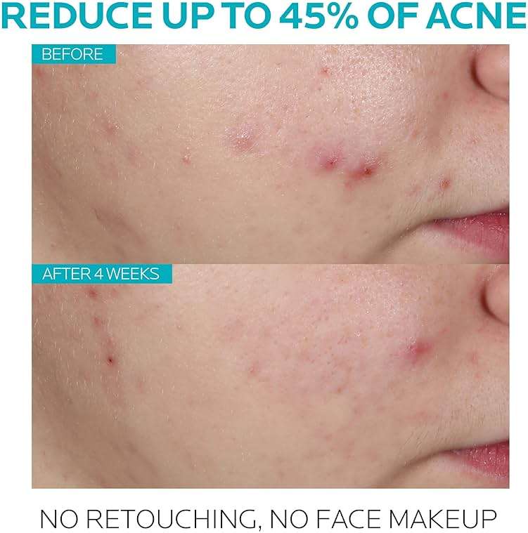 La Roche-Posay Effaclar 1.5% Salicylic Acid Serum, Acne Treatment For Face With Glycolic Acid & Niacinamide, Acne Serum Helps Clear Blackheads, Whiteheads, Pimples & Reduces Post Acne Marks - Image 2