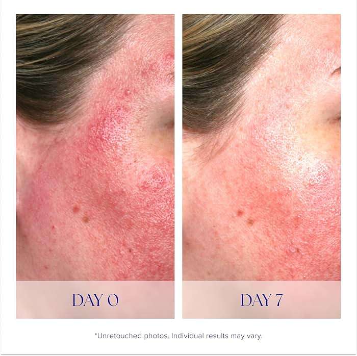 iS CLINICAL Pro-Heal Serum Advance+ - Antioxidant-Rich Vitamin C Serum, Calms Sensitivity & Irritation, Helps Redness, Anti-Aging - Image 4