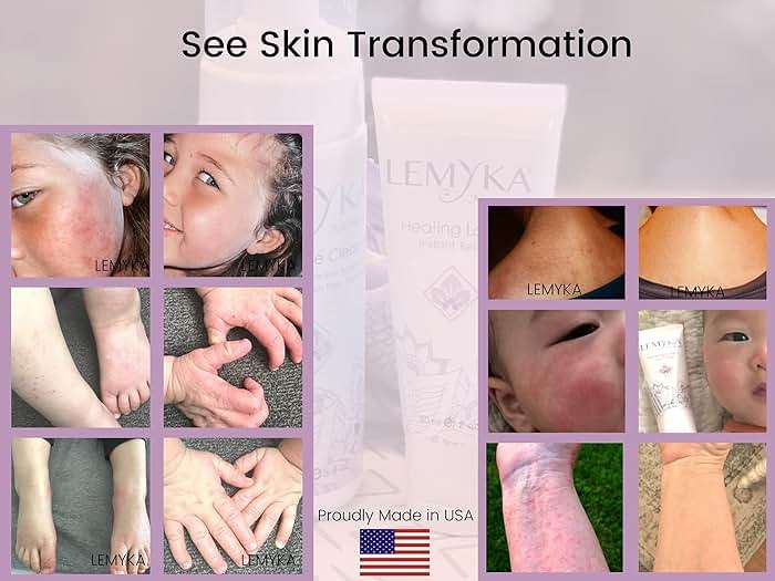 Rosacea cream -face redness relief facial rash lotion for eczema, psoriasis, hives, and dry skin, LEMYKA natural healing for babies and adults - Image 5