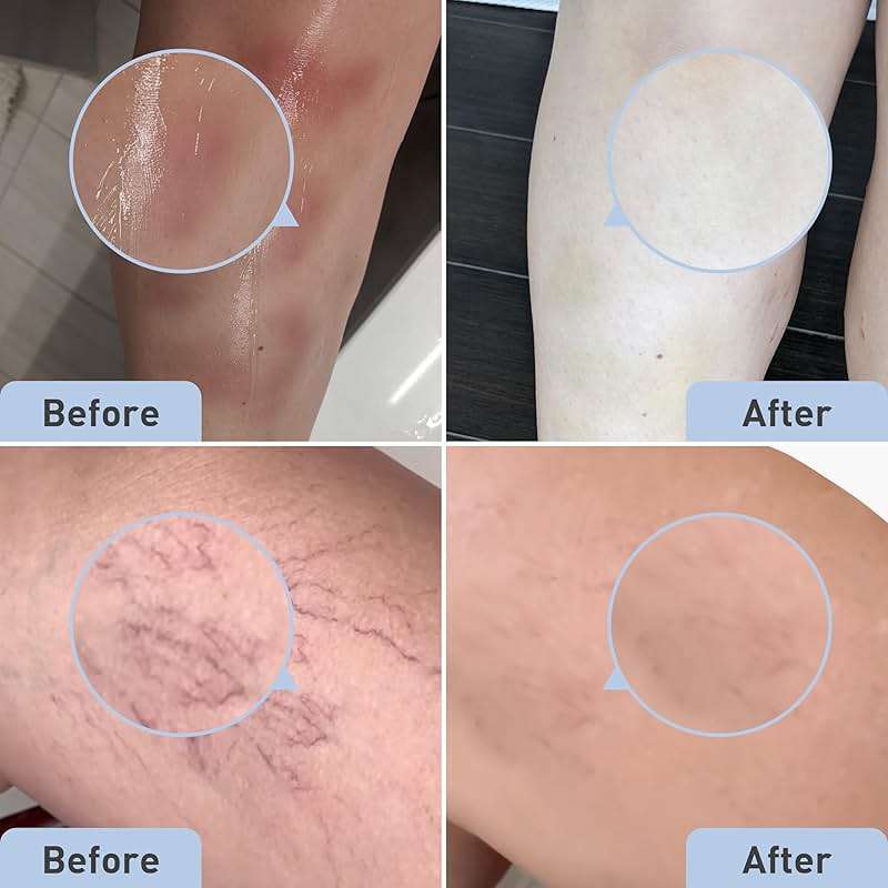 PROcure Bruise Remedy Gel, Arnica Gel for Bruises and Spider Veins - Image 6