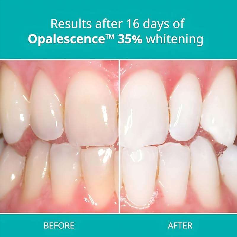 Opalescence 35% Gel Syringes Teeth Whitening - Refill Kit (4 Syringes Total) Carbamide Peroxide. Made by Ultradent, in Melon Flavor. Tooth Whitening Refill Syringes 5404-2 - Image 3