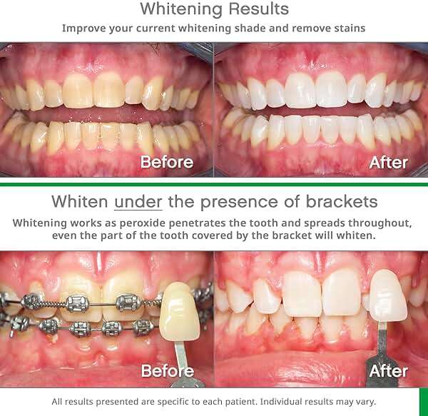 Opalescence Go 10% - Prefilled Teeth Whitening Trays Kit (10 Treatments) - 10% Hydrogen Peroxide - Mint Made by Ultradent Products. Go Teeth Whitening Kit -Mint- GO10-5193-1 - Image 3