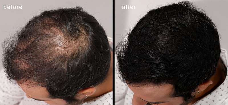 LUXE Hair Building Fibers - Thickening Fibers - CONFIDENCE IN A JAR – 2 + Months Supply – Hypoallergenic, Dermatologist Tested – Multiple Colors Available (Black) - Image 6