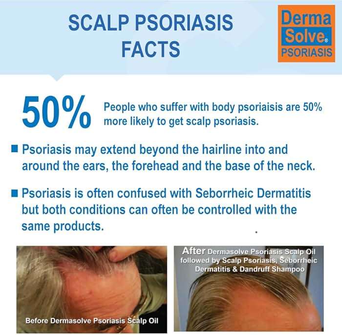 Dermasolve Scalp Psoriasis Medicated Shampoo & Conditioner - Naturally Heals Dandruff Seborrheic Dermatitis Itchy Flakey Inflamed Skin & Provides Soothing Moisturizing Relief - 8 oz bottles (2 Pack) - Image 2