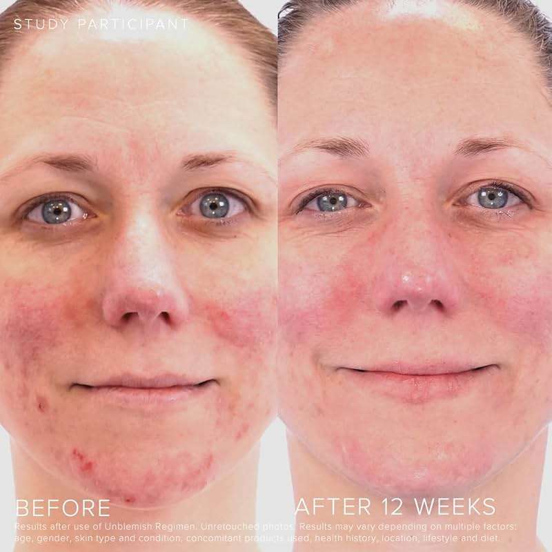 Rodan + Fields Unblemish Dual Intensive Acne Treatment | 0.76 Fl Oz | Targets Blemishes | Benzoyl Peroxide & Ceramides - Image 3