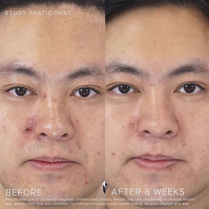 Rodan + Fields Unblemish Dual Intensive Acne Treatment | 0.76 Fl Oz | Targets Blemishes | Benzoyl Peroxide & Ceramides - Image 4