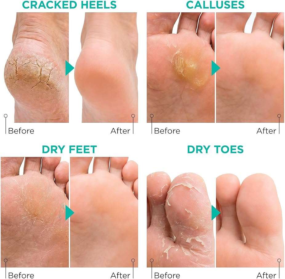 Lavinso Foot Peel Mask for Dry Cracked Feet – 2 Pack Peeling Mask Removes Dead Skin and Calluses - Exfoliating for Soft Baby Feet, Original Scent - Image 5