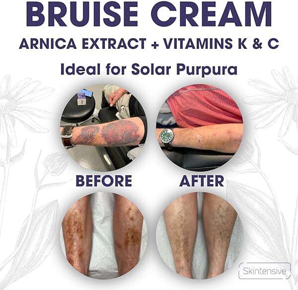 SKINTENSIVE Arnica Bruise Cream for Thin Skin – Vitamin K Cream for Bruises & Skin Discoloration, Moisturizing Arnica Cream for Seniors, Non-Greasy Formula, 4 Oz - Image 5