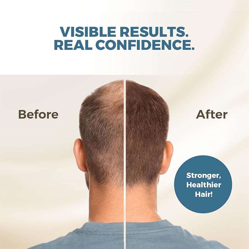 HAIRMETTO Saw Palmetto Extract Serum for Hair Loss, Hair Growth Serum with Stinging Nettle, Rosemary Oils and Peppermint Scent, Hair Serum for Men and Women - 4oz (118ml) - Image 3