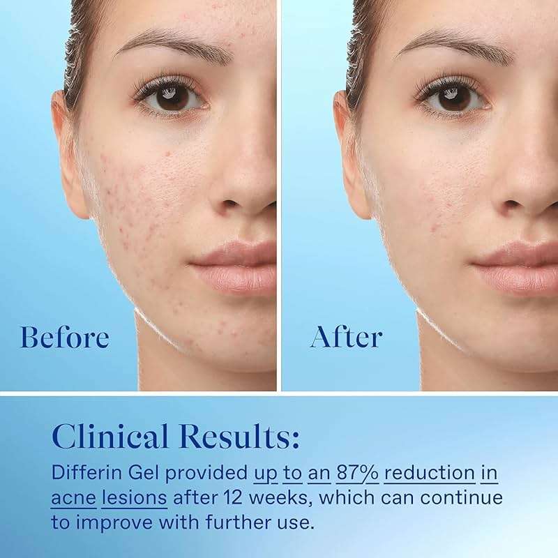 Differin Acne Treatment Gel, 30 Day Supply, Retinoid Treatment for Face with 0.1% Adapalene, Gentle Skin Care for Acne Prone Sensitive Skin, 15g Tube (Packaging May Vary) - Image 9