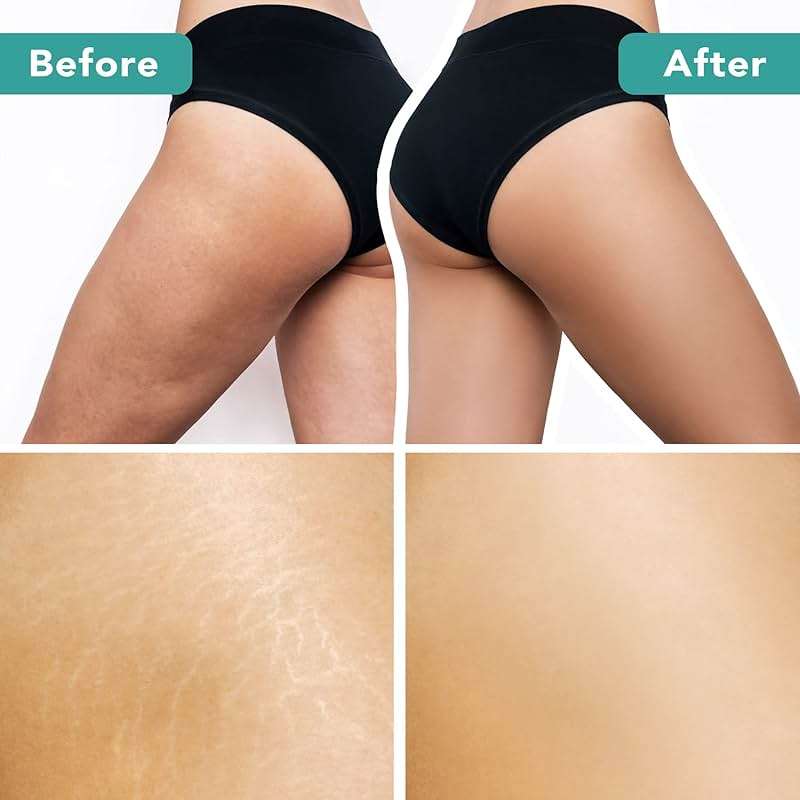 Dry Brushing Body Brush for Lymphatic Drainage & Cellulite - Natural Brustles for Wet and Dry Brushing, Body Exfoliating Brush with Massage Nodes for Soft & Smooth Skin - Image 9