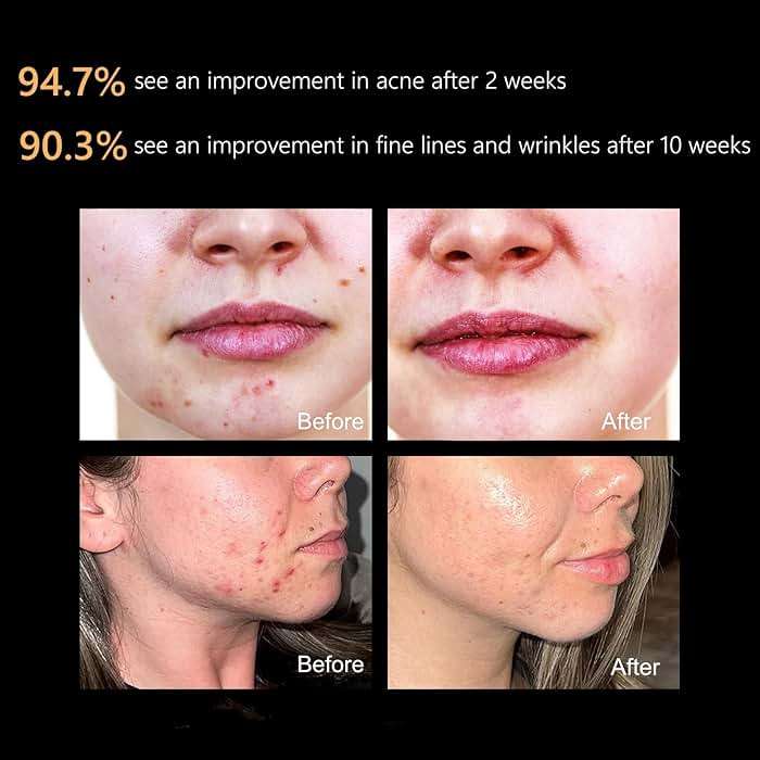 Aphrona FDA cleared LED Facial Skin Care Mask MOONLIGHT PRO 7 Color Treatment Photon Mask (White) - Image 4
