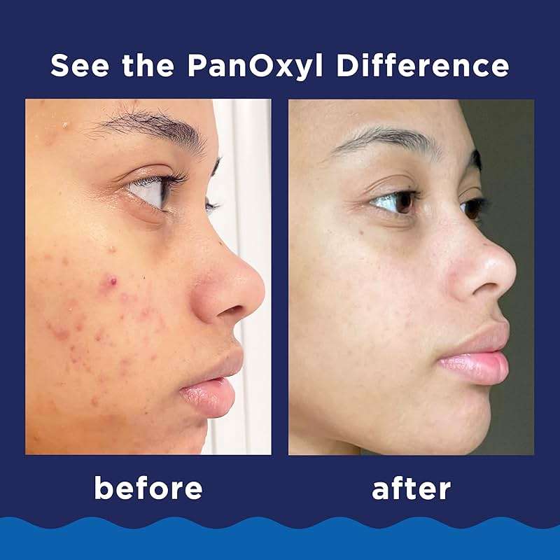PanOxyl 10% Benzoyl Peroxide Acne Foaming Wash, Maximum Strength, Daily Acne-Fighting Face and Body Cleanser, Face Wash to Clear, Treat and Prevent Acne Pimples and Stubborn Breakouts, 5.5 Oz Tube - Image 4
