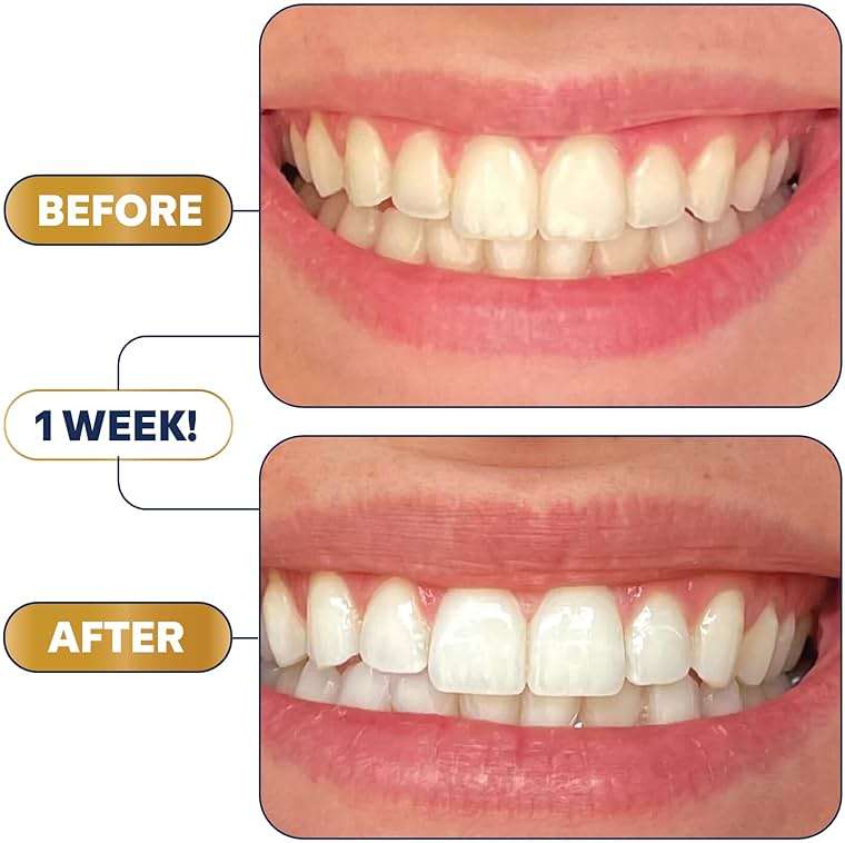 Lumineux Teeth Whitening Strips 21 Treatments – Peroxide Free - Enamel Safe for Whiter Teeth - Whitening Without The Sensitivity - Dentist Formulated - Sensitivity - Image 4