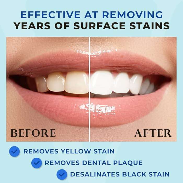 Venus Visage Award Winning Teeth Whitening Pen, 20+ Uses - Teeth whitening Kit Professionally formulated - Best Teeth whitening Gel Pen Teeth Whitener - Low Sensitivity (Mint) (0.07 Fl Oz (Pack of 2)) - Image 2