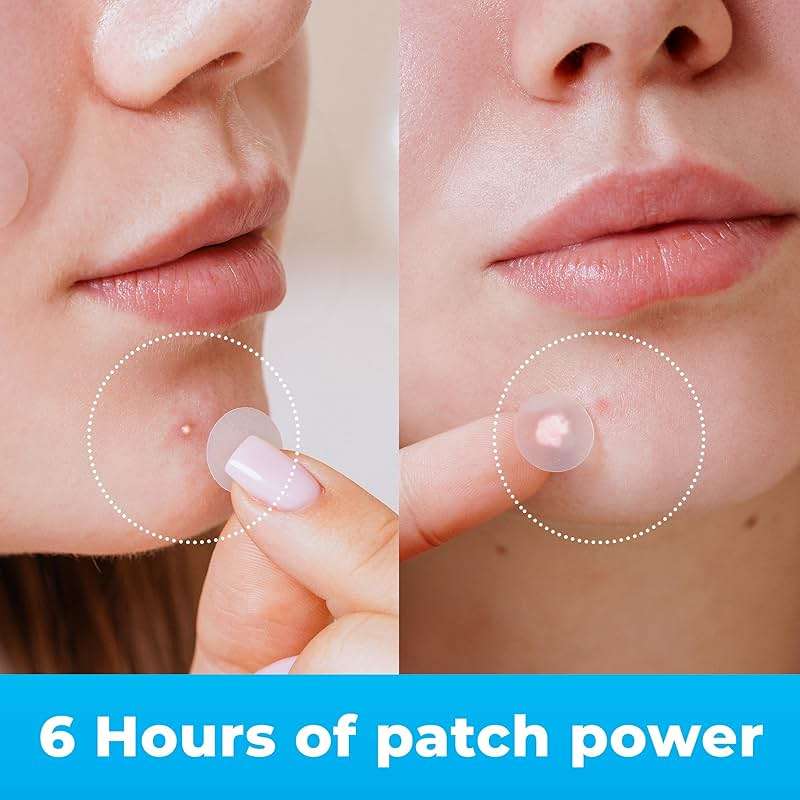 PatchRx Pimple Patches for Face (120 Patches), Hydrocolloid Acne Patches with Tea Tree Oil, Pimple Patch Pimple Stickers - Hydrocolloid Patch Acne Dots - Acne Pimple Patches For Face - Zit Patches - Image 4
