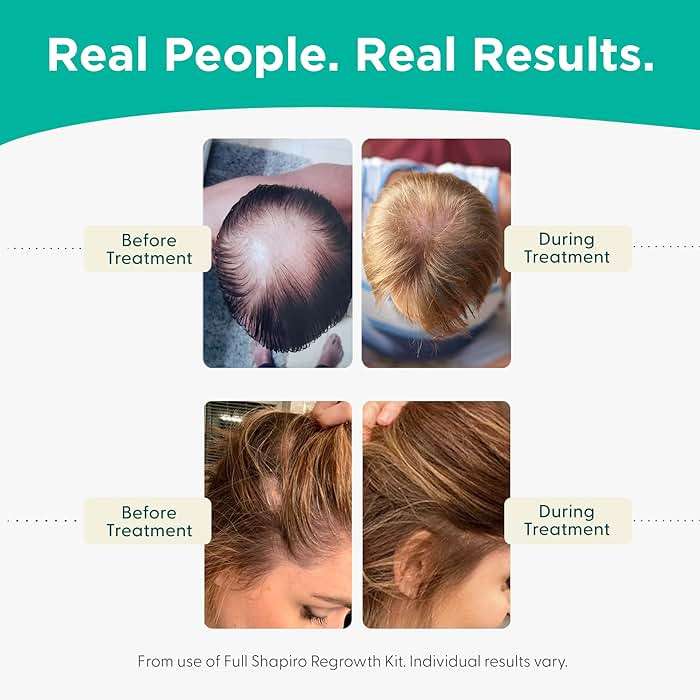 Shapiro MD Hair Growth Experts Shampoo and Leave in Conditioner, DHT Fighting Vegan Formula for Thinning Hair Developed by Dermatologists, Experience Healthier, Fuller Thicker Looking Hair, 1 Month - Image 5
