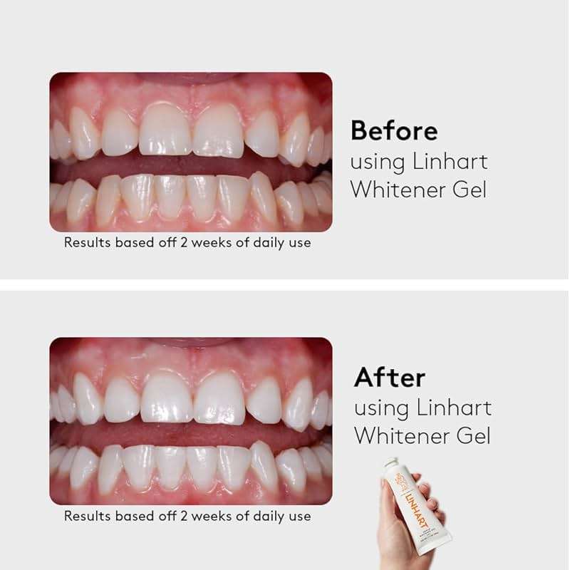 LINHART Teeth Whitening Kit with LED Light - Tooth Whitener Gel, Dental Whitening Gel Syringes with 35% Carbamide Peroxide and 16-Led Whitening Light - No Sensitivity, Whitens Teeth - Image 9