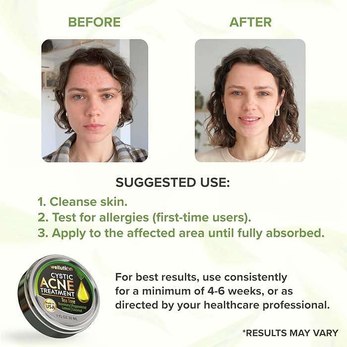 Cystic Acne Spot Treatment – Tea Tree Acne Cream – Fast-Acting Acne Spot Corrector for Face, Pimples & Blemishes – Non-Greasy, Gentle Formula – 1oz – by WELLUTION - Image 5