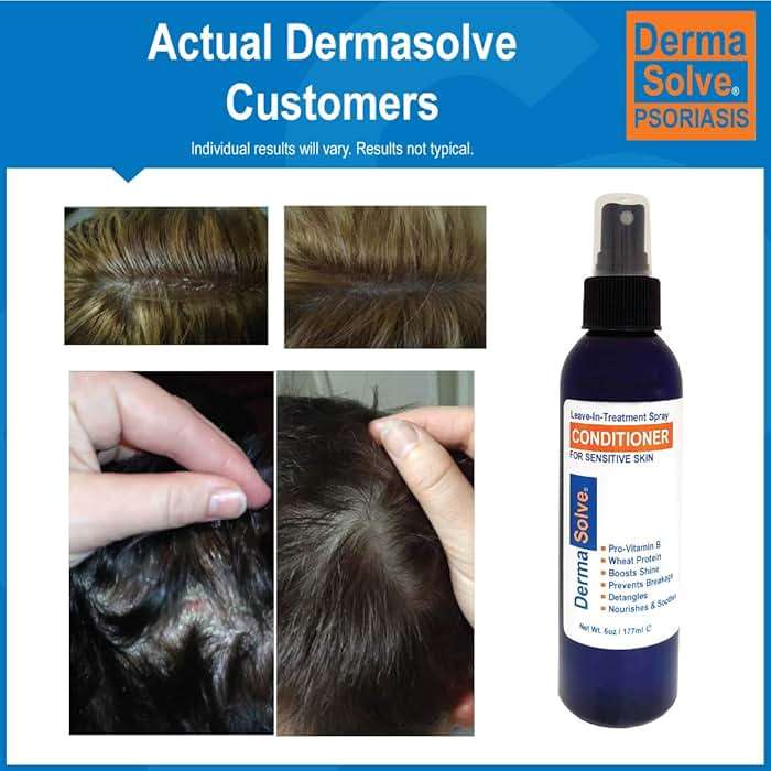 Dermasolve Psoriasis Leave-In-Treatment and Styling Spray Conditioner for Seborrheic Dermatitis, Sensitive Skin, Detangle, De-Flake, Soothing Anti Dandruff, Dry Scalp Repair for Damaged Hair - Image 6