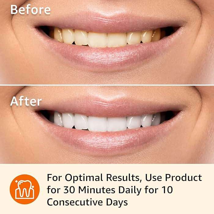 Amazon Basics 10 Day Teeth Whitening Strips Kit, 10 Treatments, 1-Pack, Packaging May Vary - Image 5