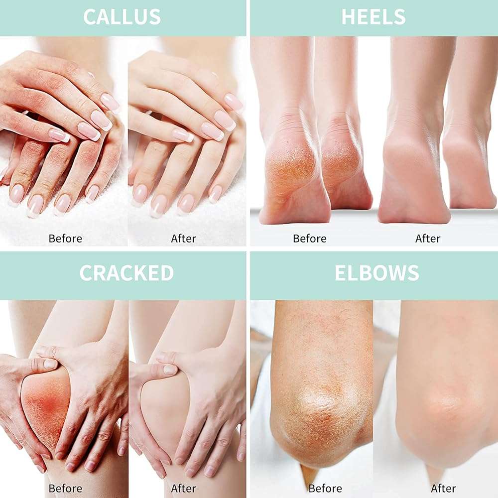 Grocerism Urea Cream 40 Percent For Feet Plus 2% Salicylic Acid 5.29 oz || Foot Cream and Hand Cream Maximum Strength with Hyaluronic Acid,Tea Tree,and Aloe Vera For Deep Moisturizes,Callus Remover - Image 4