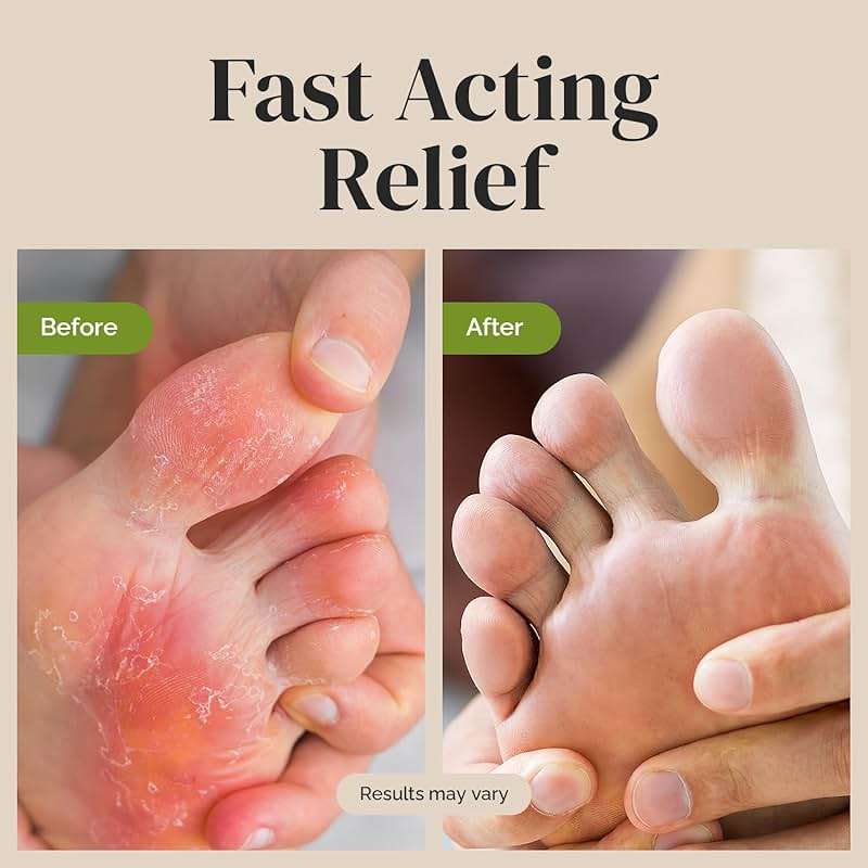 Puriya Clinically Proven Antifungal Cream for Skin Fungus, Extra-Strength Athletes Foot Cream Treatment, Jock Itch, Ringworm Treatment for Humans, Anti Fungal Itchy Skin Relief with Tea Tree Oil - Image 3