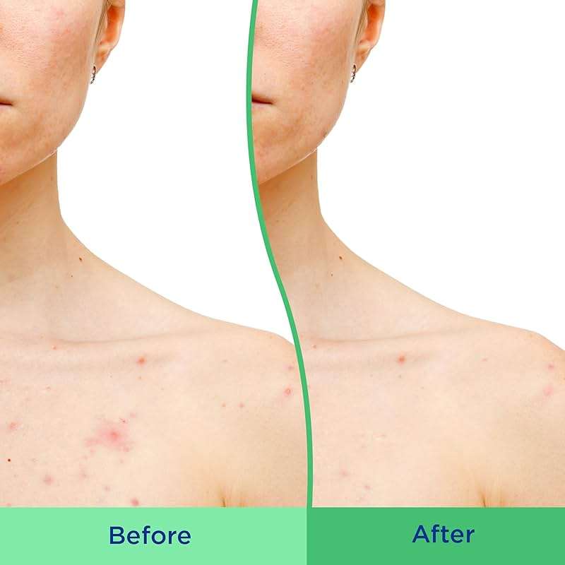 Differin Body Scrub with Salicylic Acid Acne Clearing Improves Tone and Texture Prone Skin on Back Shoulders and Chest, 8 Oz (Packaging May Vary) - Image 4
