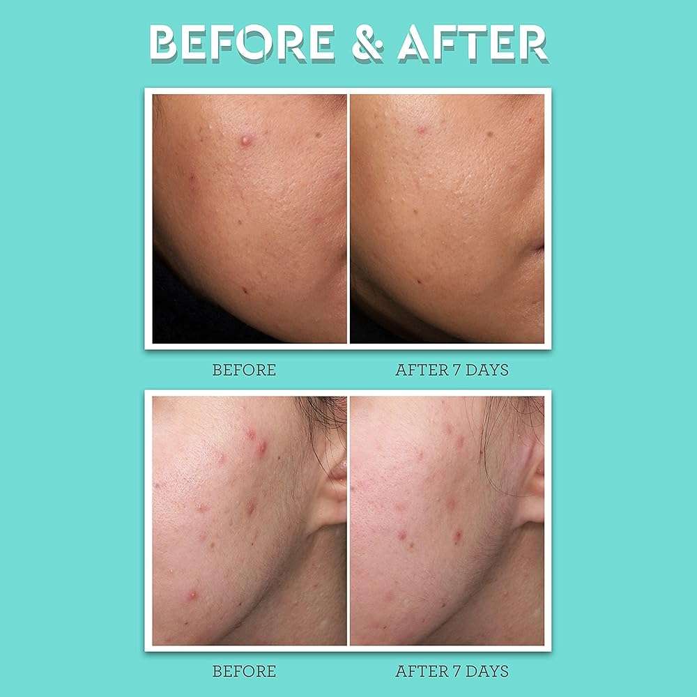 Bliss Clear Genius Acne Spot Treatment – Maximum Strength 2% Salicylic Acid Shrinks Blemishes – Clean, Vegan, Cruelty-Free, 0.5 Fl Oz - Image 7
