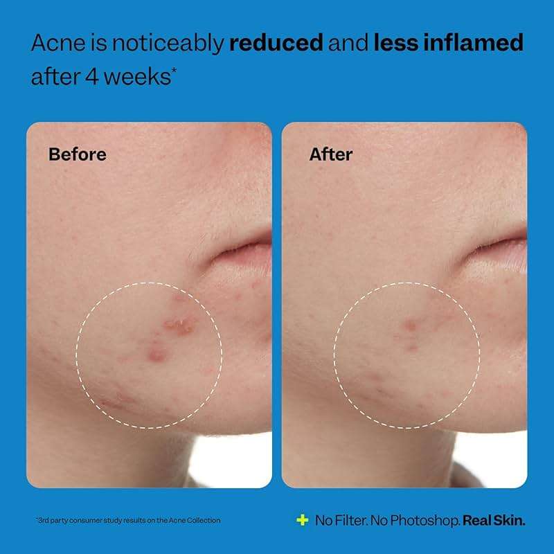 Peach Slices - Acne Exfoliating Toner (4.05 oz) - 2% Salicylic Acid Acne Treatment - Clear & Prevent Breakouts - Lactic & Glycolic Acid - Cucumber - Vegan, Cruelty Free, Korean Skin Care & Beauty - Image 6
