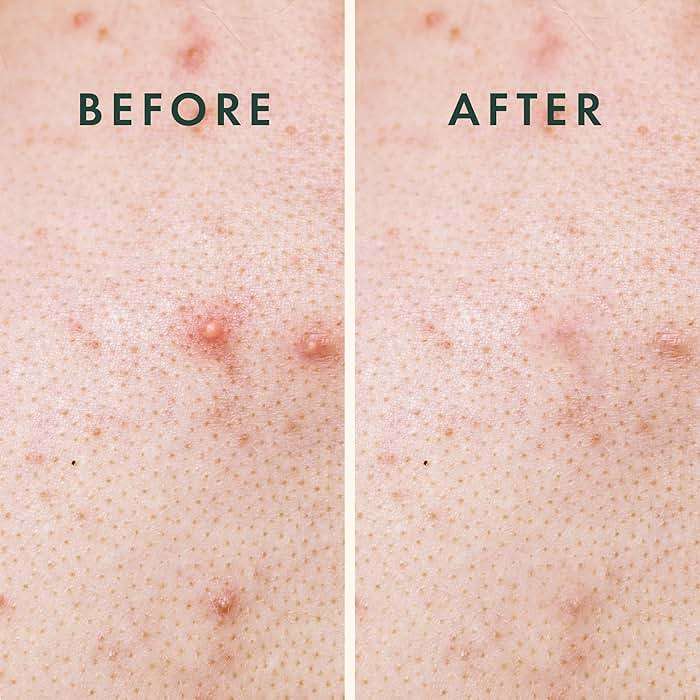 Rael Pimple Patches, Miracle XL Spot Control Cover - Hydrocolloid Acne Pimple Patch for Face, Zits & Blemish, Back and Body, Korean Skin Care (8 Count) - Image 5