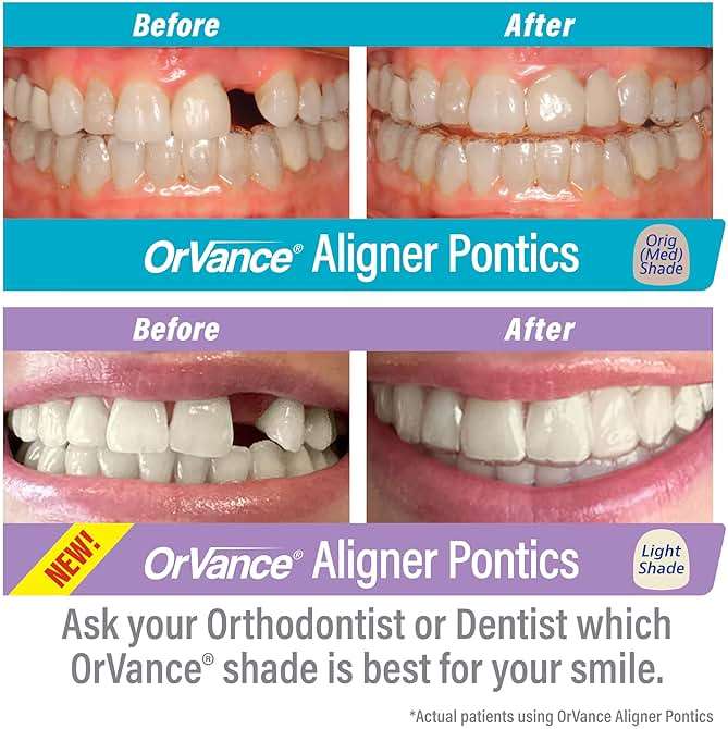 ORVANCE Aligner Pontics - Original (Medium) Shade (16 Count) | Temporary Tooth Replacement for Invisalign, Aligner Trays and Clear Retainers During Orthodontic Treatment - Image 4