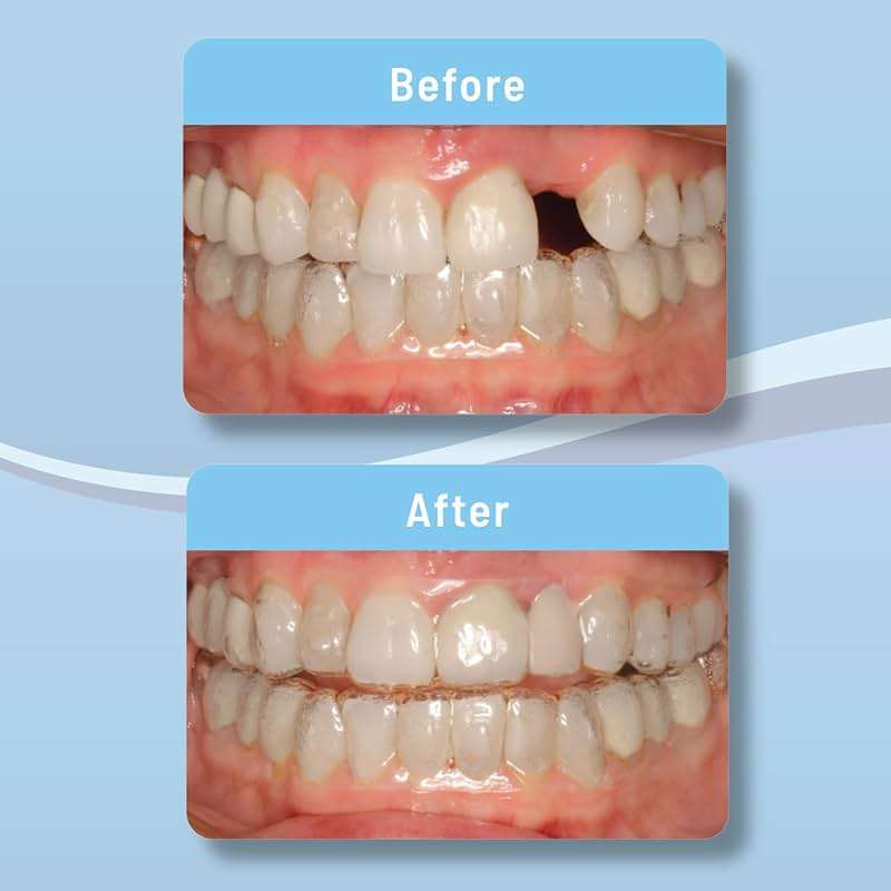 ORVANCE Aligner Pontics - Original (Medium) Shade (16 Count) | Temporary Tooth Replacement for Invisalign, Aligner Trays and Clear Retainers During Orthodontic Treatment - Image 9