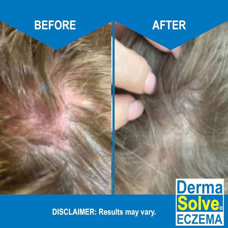 Eczema Shampoo & Conditioner (Combo Pack) - Flare Control Scalp & flake Relief Therapy that Protects, Moisturizes, and Repairs Skin by DermaSolve - Kids & Adults - Steroid Free - Image 5
