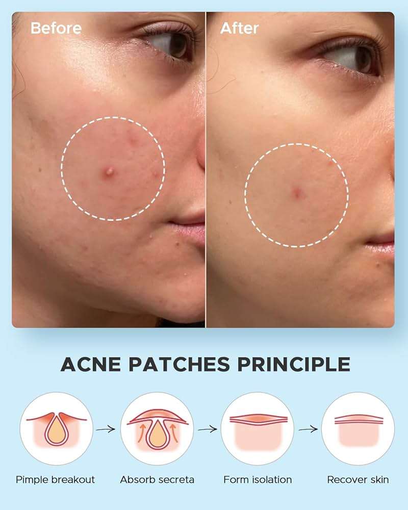 LitBear Acne Pimple Patches- Day and Night 4 Sizes 180 Dots Thin & Thick Hydrocolloid Patches with Witch Hazel, Tea Tree & Calendula Oil, Pimple Stickers for Covering Zits, Blemishes, Spots, Acne Dots - Image 6