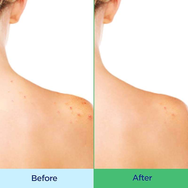 Differin Acne Body Wash by the makers of Differin Gel, Acne Treatment Cleanser with Salicylic Acid, Cream to Lather Formula for Back, Chest, Shoulders, 10 Oz. - Image 3