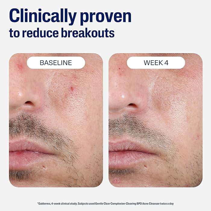 Cetaphil Gentle Clear Complexion-Clearing BPO Acne Cleanser with 2.6% Benzoyl Peroxide, Creamy and Soothing for Sensitive Skin, Suitable for All Skin Types, 4.2oz - Image 6