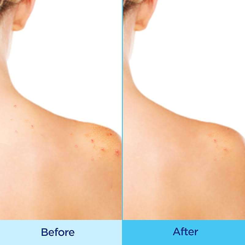 Differin Acne Body Spray, Acne Treatment with Salicylic Acid by the makers of Differin Gel, 360 Formula for Back Acne, Chest and Shoulders, 6 oz - Image 3