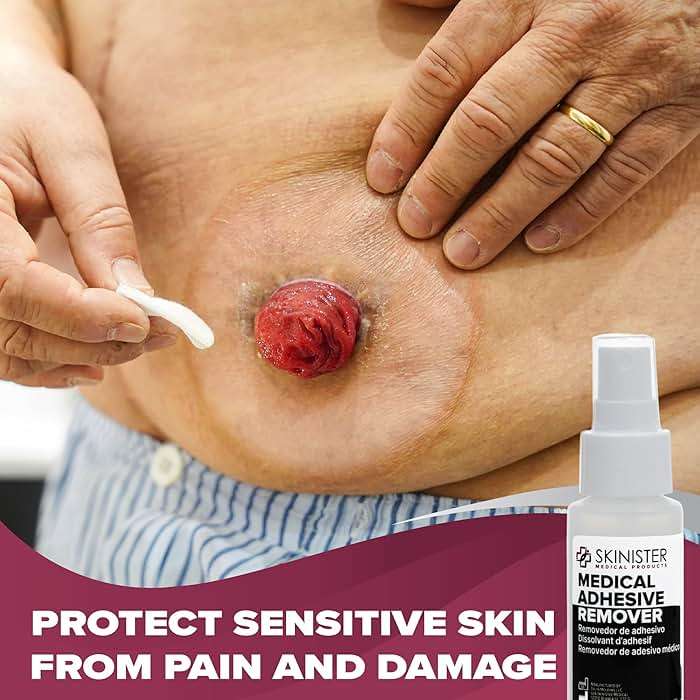 Skinister Medical Adhesive Remover for Skin | Wig, Ostomy, Tape, and Bandage Adhesive Remover | Silicone-Based, Hypoallergenic, Sting-Free | 2oz Spray - Image 5