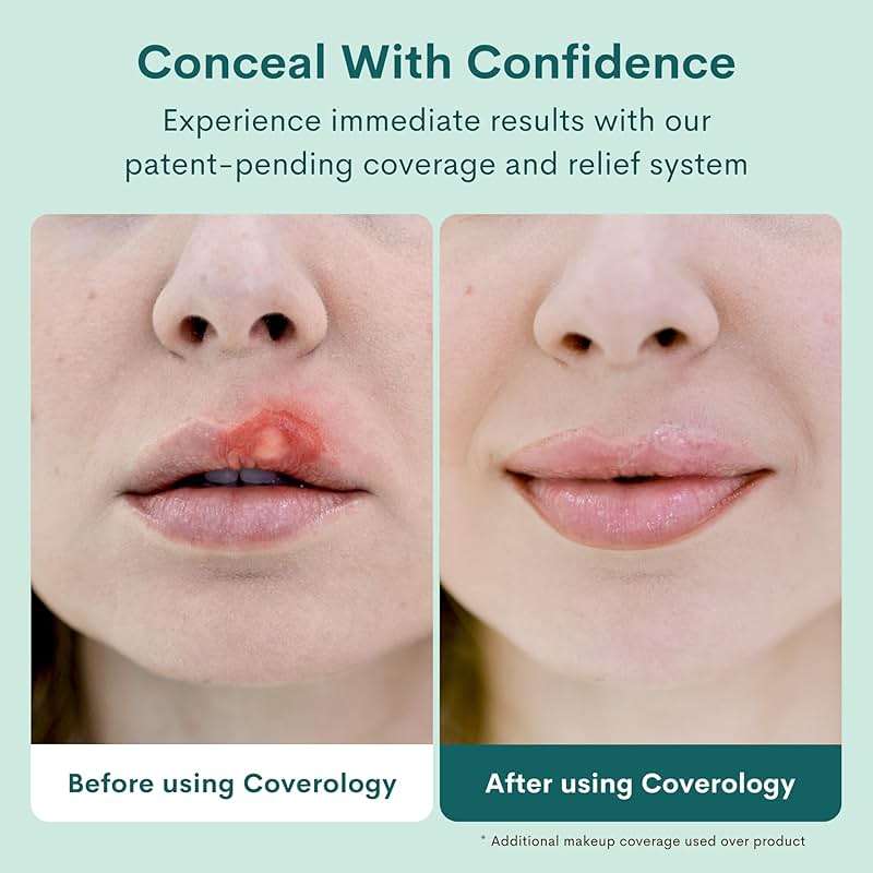 Coverology Cold Sore Treatment & Cold Sore Concealer - The Best Full Coverage Cold Sore Cover Up Makeup to Help Disguise and Soothe - Light - Image 5