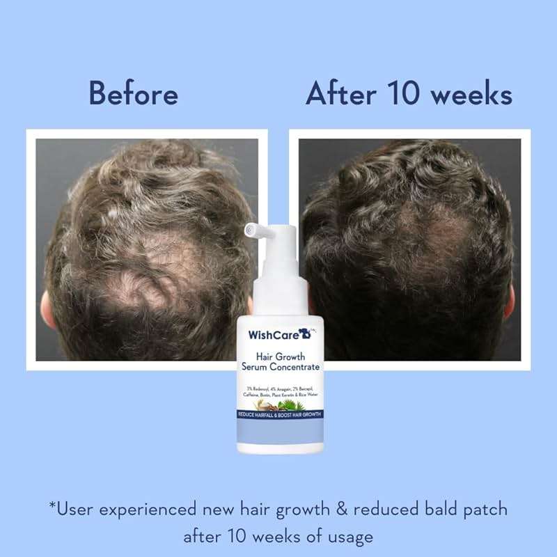 WishCare Hair Growth Serum Concentrate - Rosemary, 3% Redensyl, 4% Anagain, 2% Baicapil, Caffeine, Biotin, Plant Keratin & Rice Water - Image 3