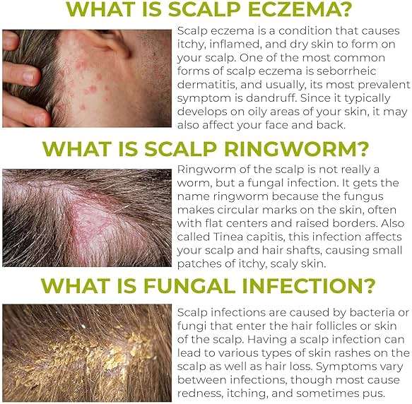 Folliculitis Shampoo | Antifungal Shampoo for Seborrheic Dermatitis, Scalp Psoriasis & Dandruff | Soothes Itchy, Dry Scalp | Cleanses, Exfoliates & Removes Build-Up | Reactivates Hair Follicles - Image 3