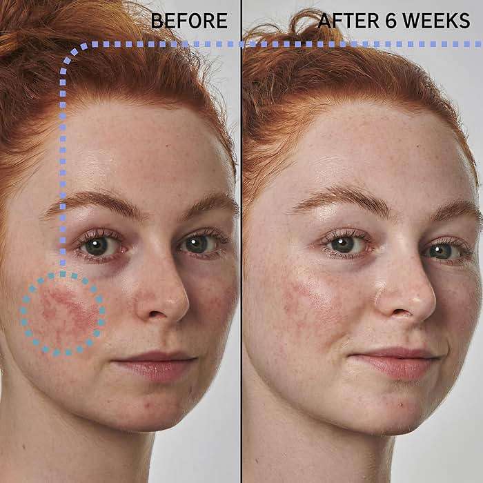 The INKEY List SuperSolutions Azelaic Acid 10% Serum, Fast-Absorbing Formula Helps Reduce Appearance of Redness and Soothes Skin, Leaves No White Cast, 1.01 fl oz - Image 2