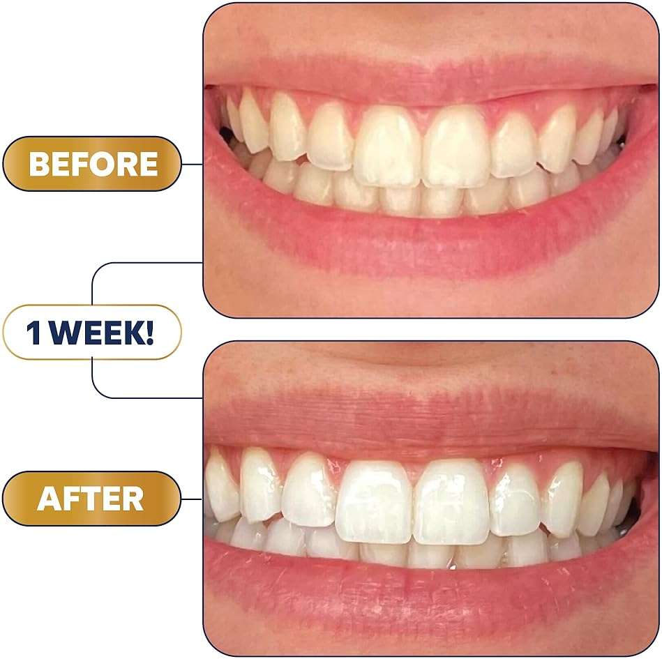 Lumineux 2-in-1 Whitening Pen Enamel Safe and Clinically Proven to Whiten Without The Sensitivity - Removes Coffee, Tea, and Smoking Stains - Image 7