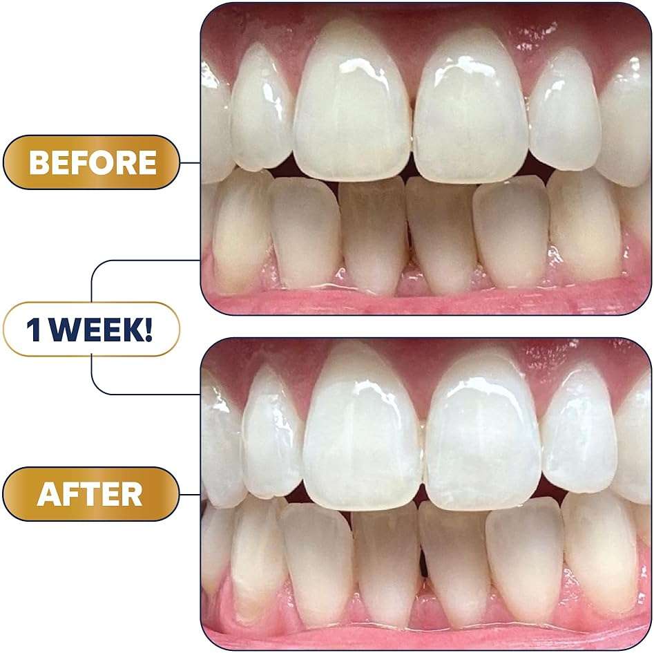 Lumineux 2-in-1 Whitening Pen Enamel Safe and Clinically Proven to Whiten Without The Sensitivity - Removes Coffee, Tea, and Smoking Stains - Image 8
